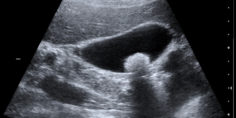 Gallstone