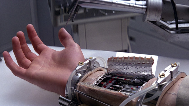 Prosthetic arm w/ carbon nanotubing via Luke Skywalker.