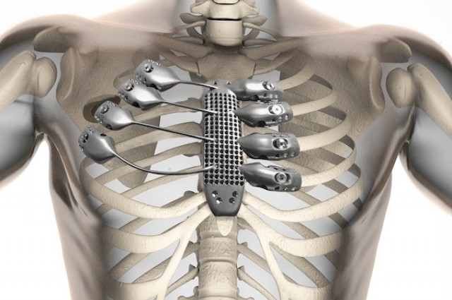 Titanium Rib Cage